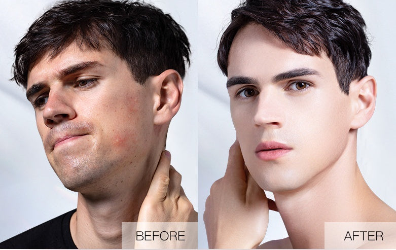 Plant Extract Warm And Moisturizing Herbal Acne Cream