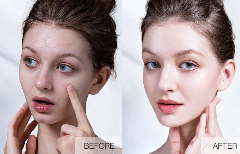 Plant Extract Warm And Moisturizing Herbal Acne Cream