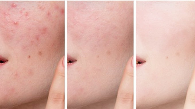 Plant Extract Warm And Moisturizing Herbal Acne Cream