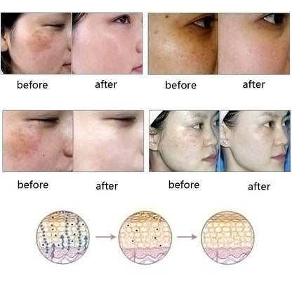 Dredge Meridian Skin Care Natural Pure Removal Acne Stretch Marks Scar Remova