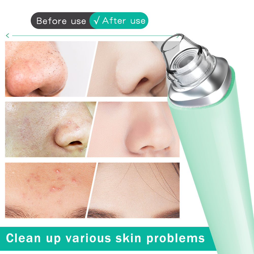 USB Rechargeable Vacuum Pimple Extractor Machine